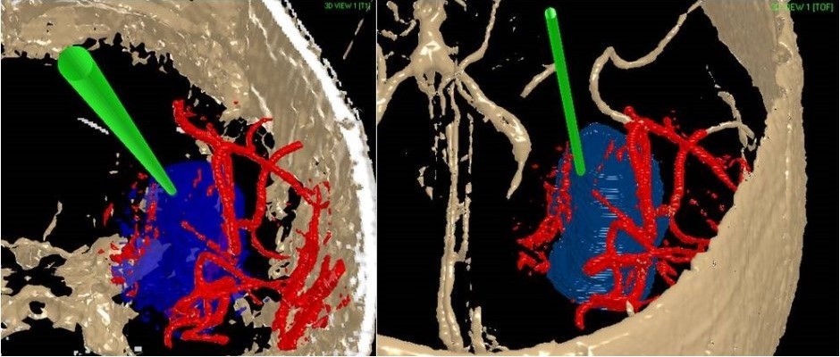 Biopsy: Pineal Tumor