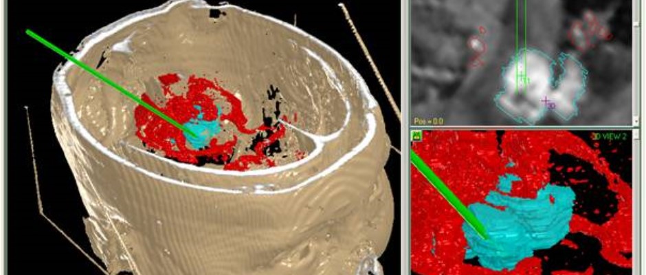 Biopsy: Important vessels surrounding the target